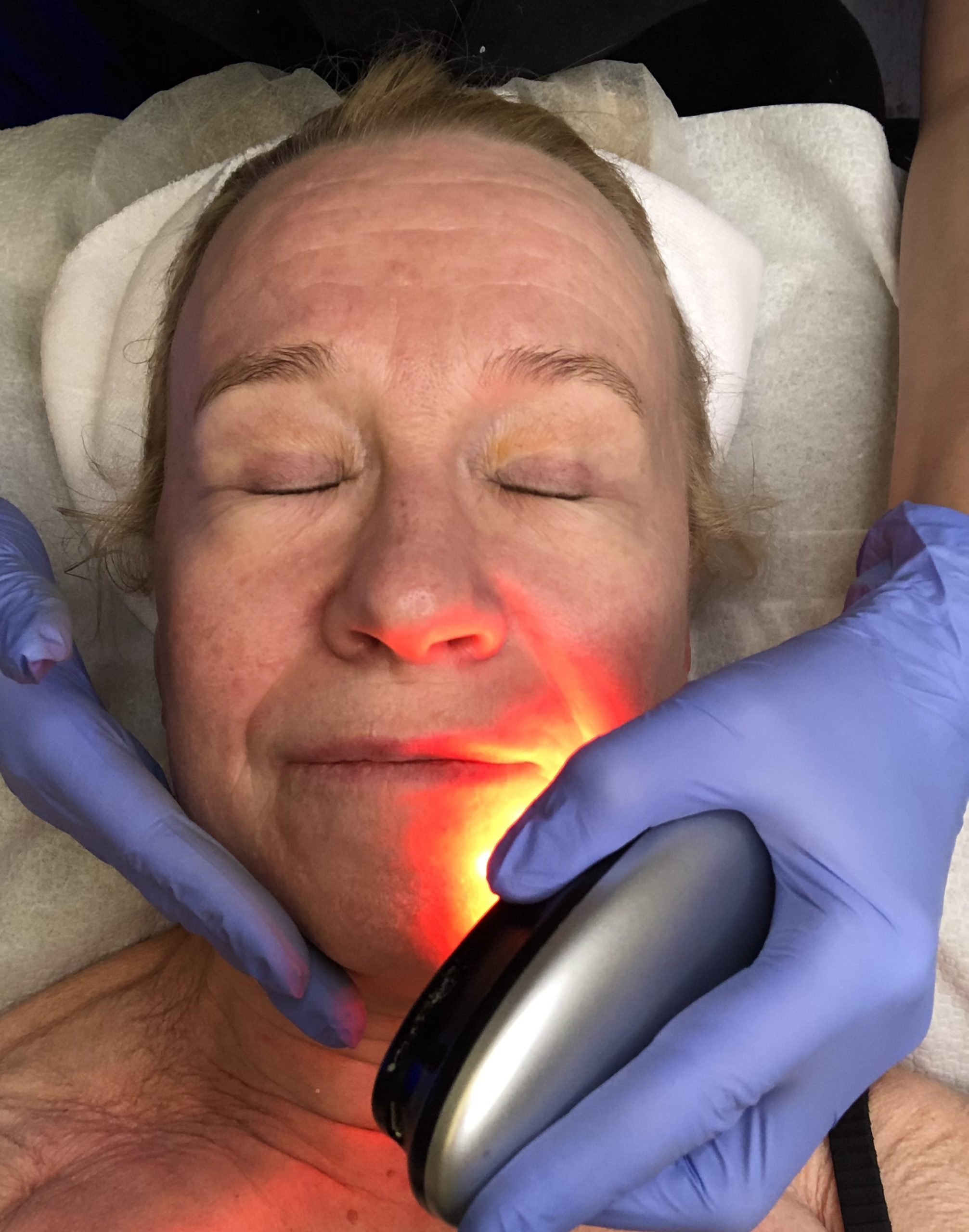 Säännöllinen kasvohoito hydrafacial led