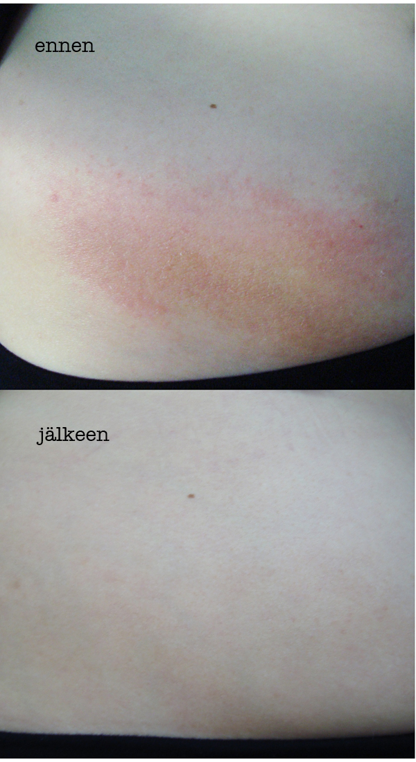Otsonoitu_testihenkilo3