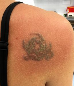 Ensimmäisen käsittelyn jälkeen.